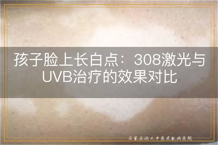 孩子脸上长白点：308激光与UVB治疗的效果对比