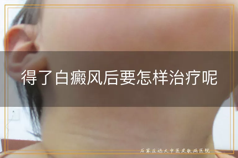 得了白癜风后要怎样治疗呢