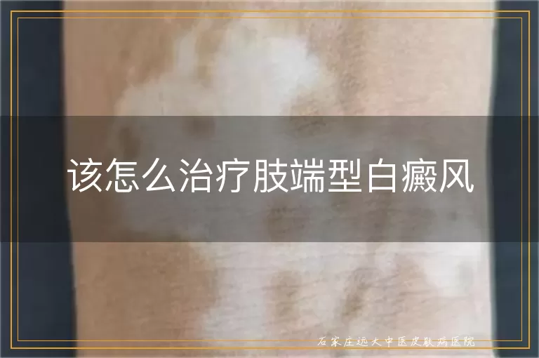 该怎么治疗肢端型白癜风