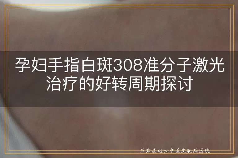 孕妇手指白斑308准分子激光治疗的好转周期探讨