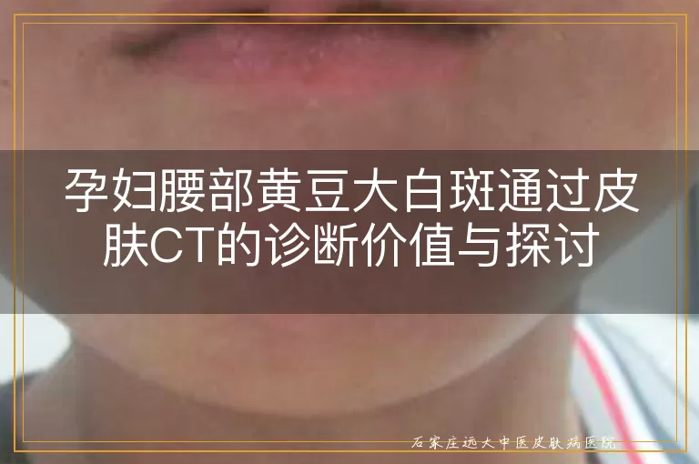 孕妇腰部黄豆大白斑通过皮肤CT的诊断价值与探讨