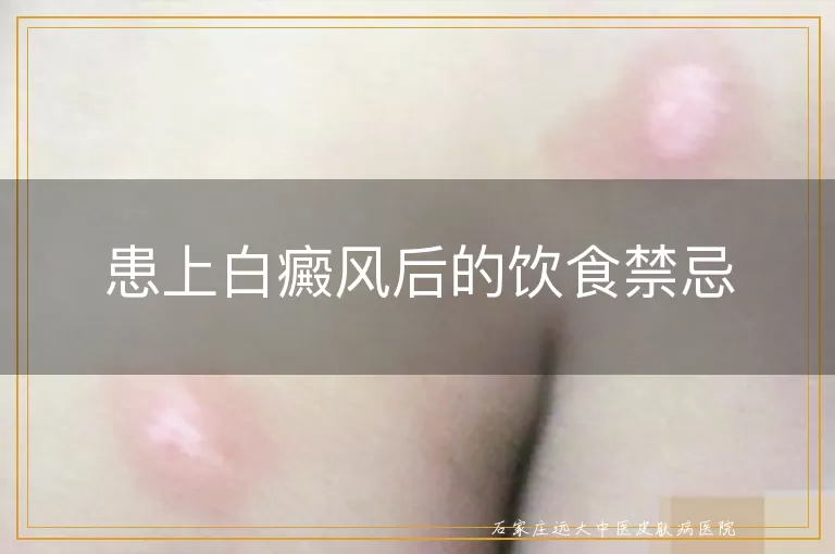 患上白癜风后的饮食禁忌