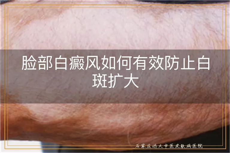 脸部白癜风如何有效防止白斑扩大