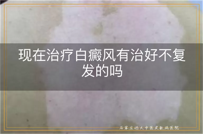 现在治疗白癜风有治好不复发的吗