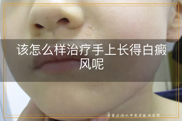 该怎么样治疗手上长得白癜风呢