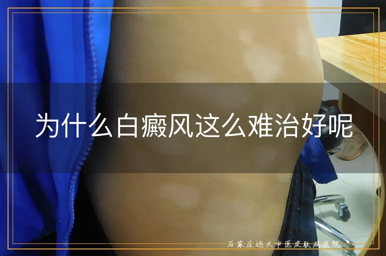 为什么白癜风这么难治好呢