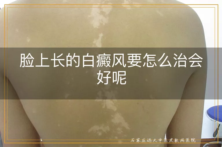 脸上长的白癜风要怎么治会好呢