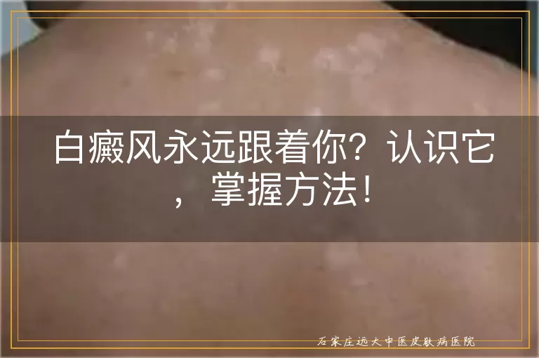 白癜风永远跟着你？认识它，掌握方法！