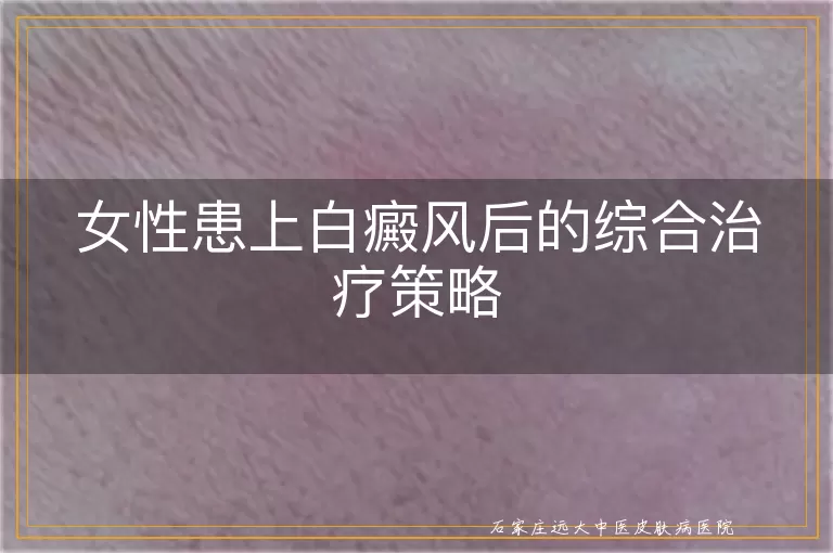 女性患上白癜风后的综合治疗策略