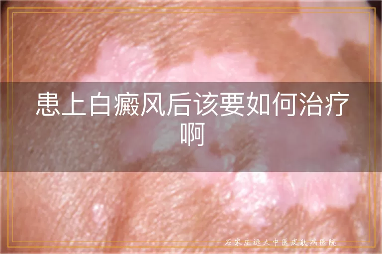 患上白癜风后该要如何治疗啊