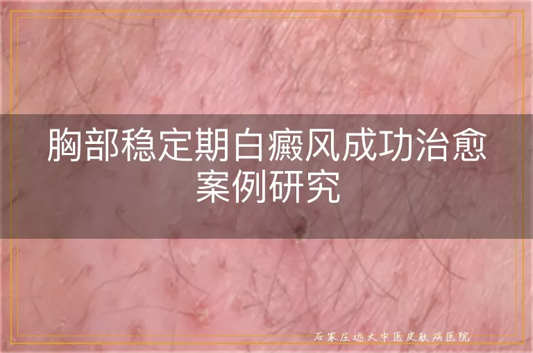 胸部稳定期白癜风成功治愈案例研究