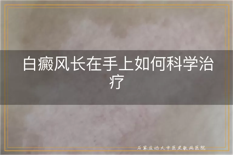 白癜风长在手上如何科学治疗