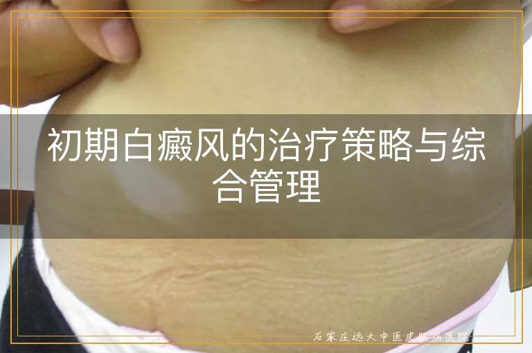 初期白癜风的治疗策略与综合管理