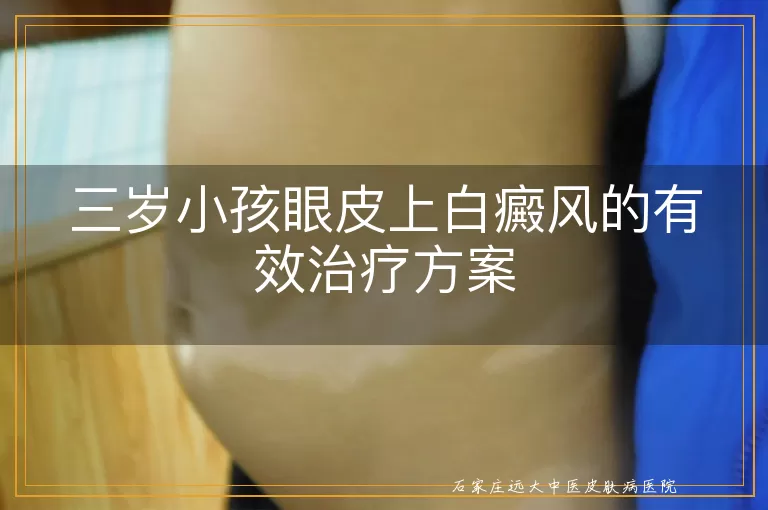三岁小孩眼皮上白癜风的有效治疗方案