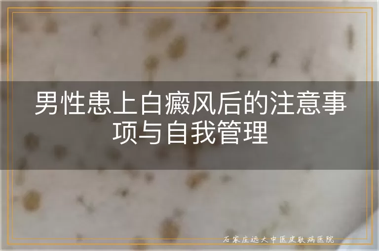 男性患上白癜风后的注意事项与自我管理