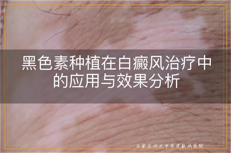 黑色素种植在白癜风治疗中的应用与效果分析