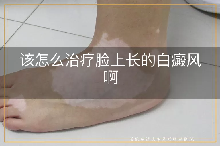 该怎么治疗脸上长的白癜风啊