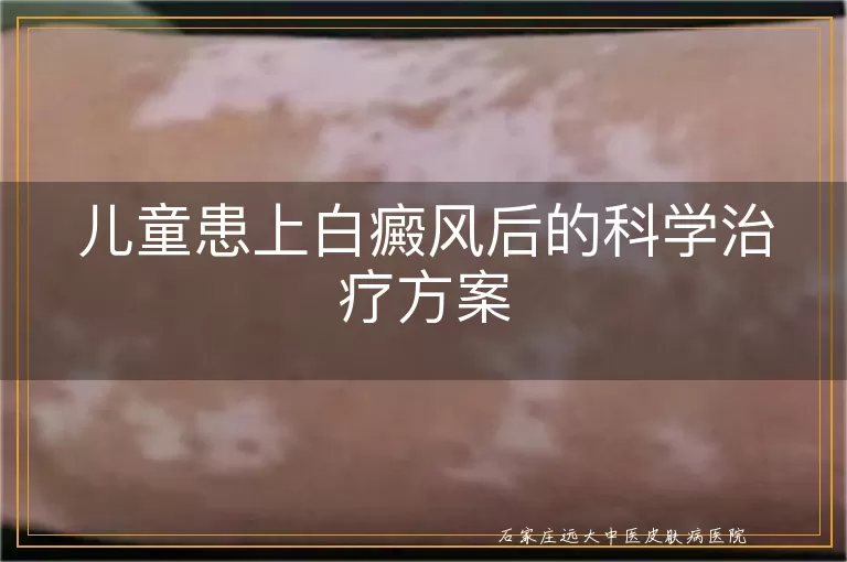 儿童患上白癜风后的科学治疗方案