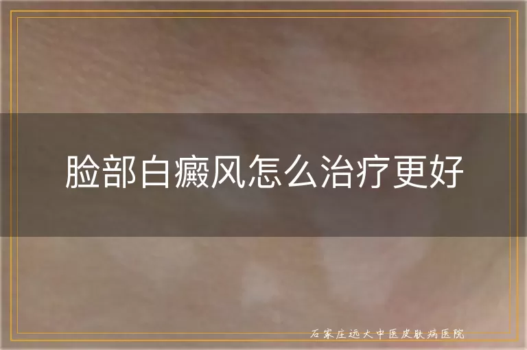 脸部白癜风怎么治疗更好