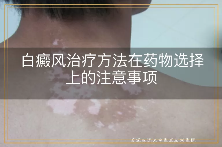 白癜风治疗方法在药物选择上的注意事项