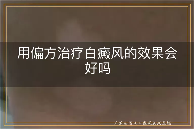 用偏方治疗白癜风的效果会好吗