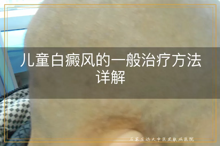 儿童白癜风的一般治疗方法详解