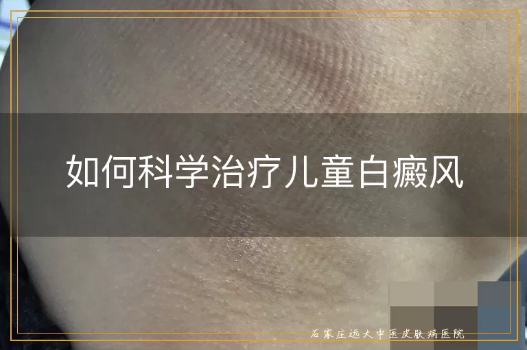 如何科学治疗儿童白癜风