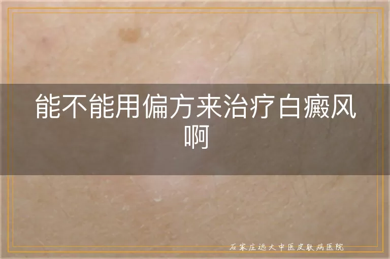 能不能用偏方来治疗白癜风啊