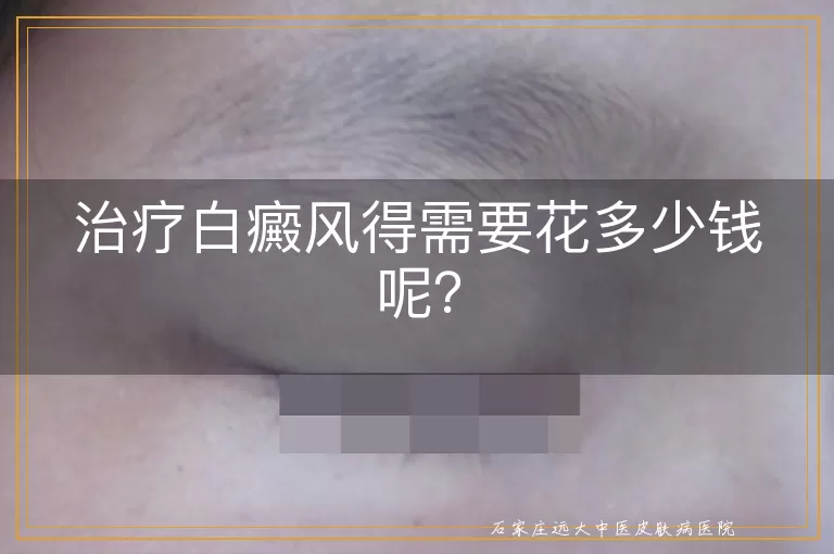 治疗白癜风得需要花多少钱呢？