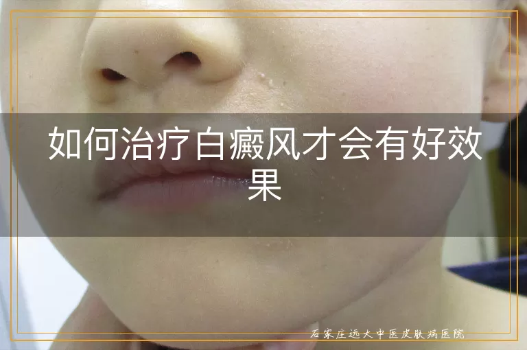 如何治疗白癜风才会有好效果