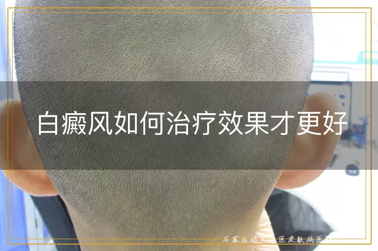 白癜风如何治疗效果才更好