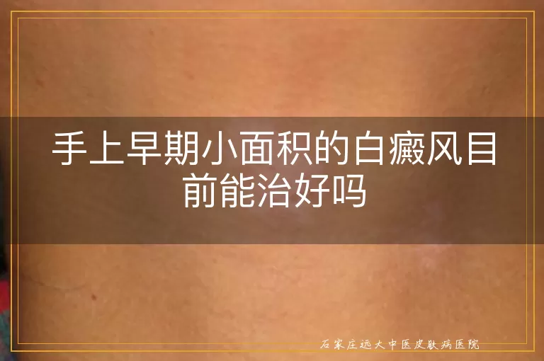 手上早期小面积的白癜风目前能治好吗
