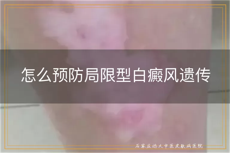 怎么预防局限型白癜风遗传