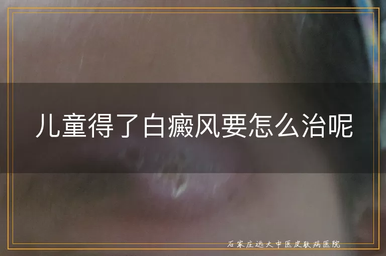 儿童得了白癜风要怎么治呢
