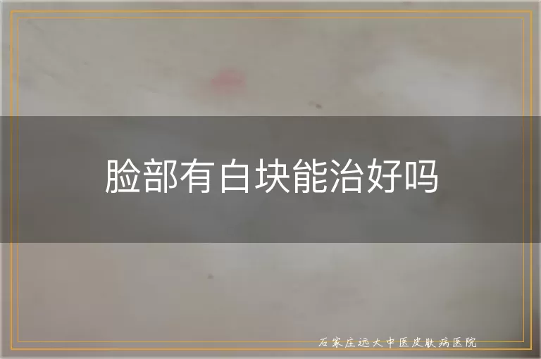 脸部有白块能治好吗