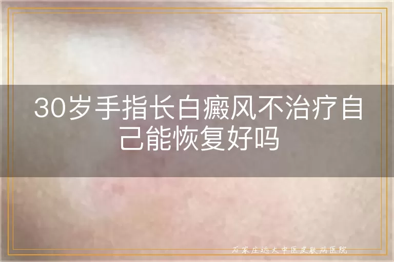 30岁手指长白癜风不治疗自己能恢复好吗