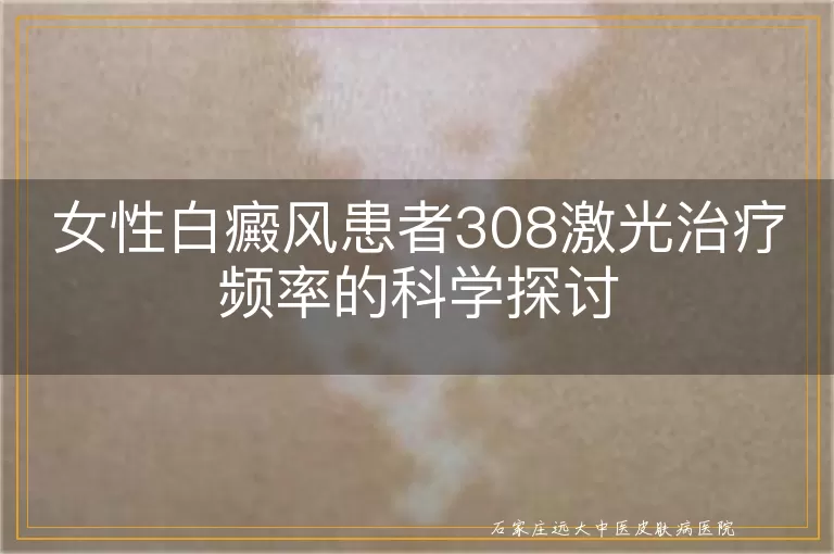 女性白癜风患者308激光治疗频率的科学探讨