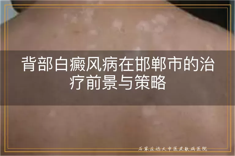 背部白癜风病在邯郸市的治疗前景与策略