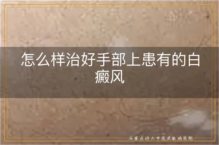 怎么样治好手部上患有的白癜风