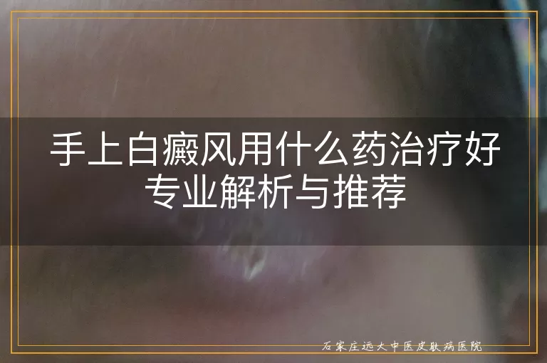 手上白癜风用什么药治疗好专业解析与推荐