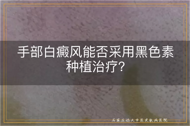 手部白癜风能否采用黑色素种植治疗？