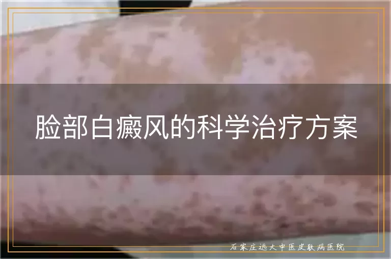 脸部白癜风的科学治疗方案