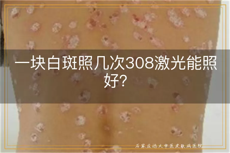一块白斑照几次308激光能照好？