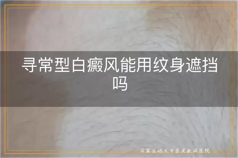 寻常型白癜风能用纹身遮挡吗