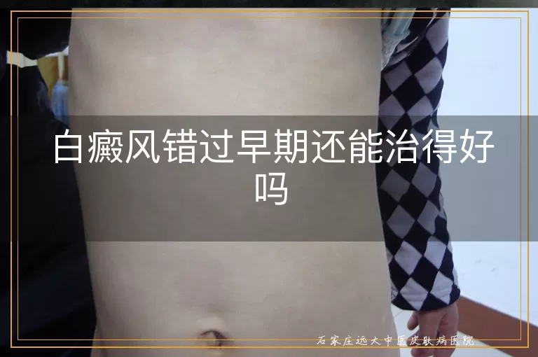 白癜风错过早期还能治得好吗
