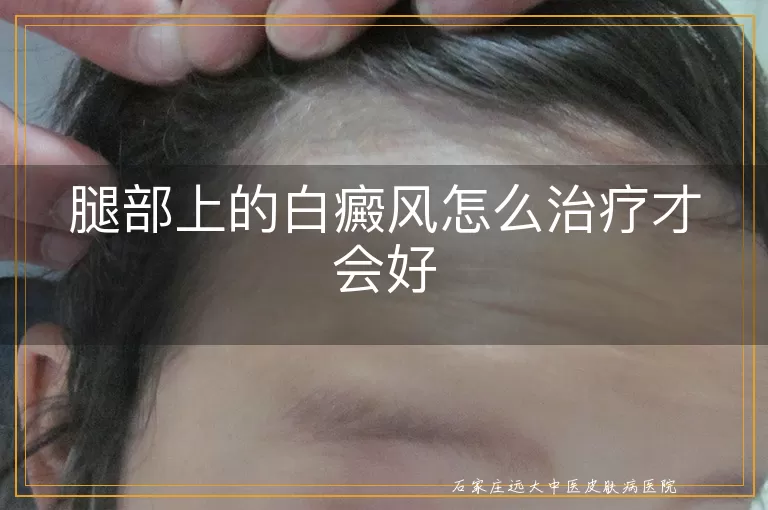 腿部上的白癜风怎么治疗才会好