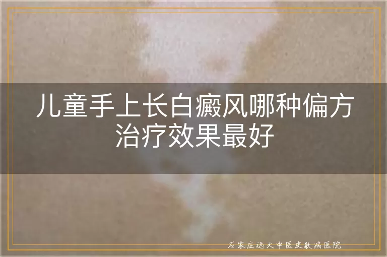 儿童手上长白癜风哪种偏方治疗效果最好