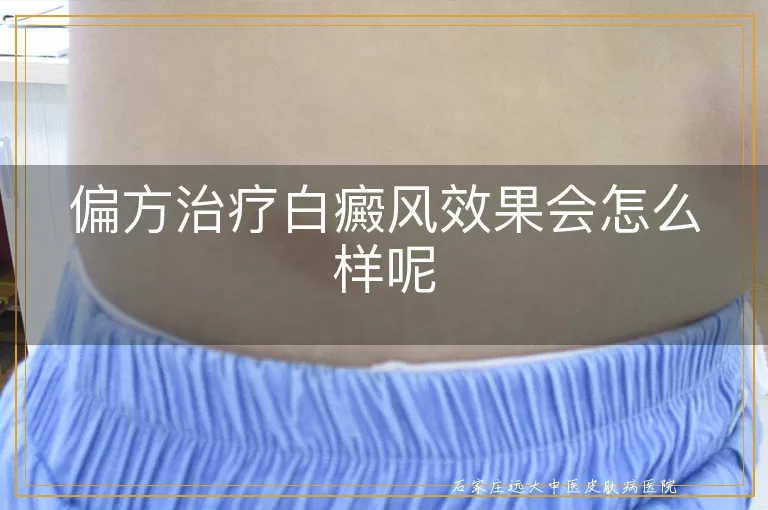 偏方治疗白癜风效果会怎么样呢