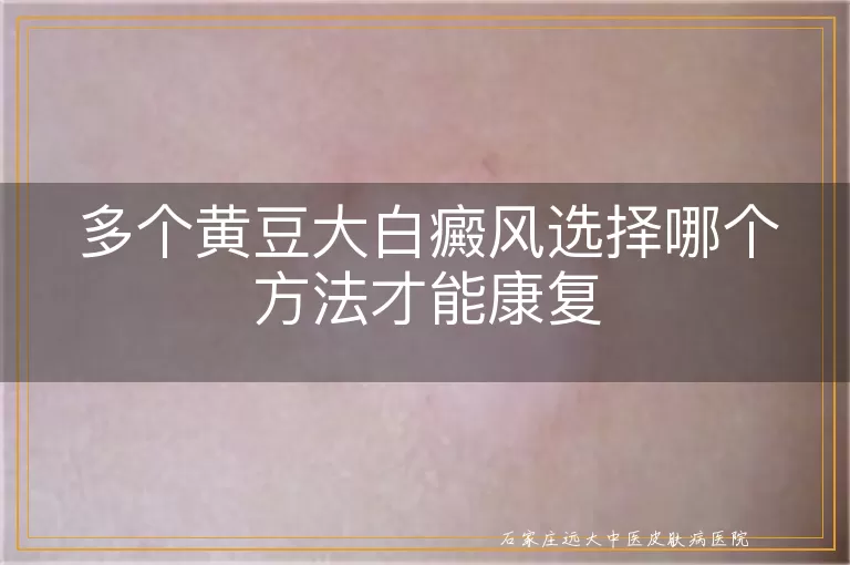 多个黄豆大白癜风选择哪个方法才能康复