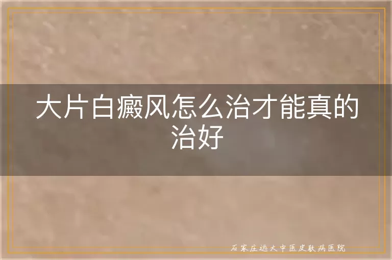 大片白癜风怎么治才能真的治好